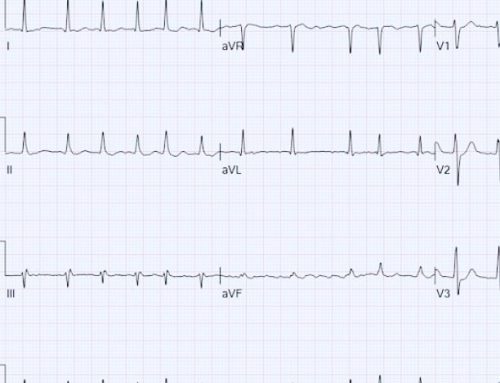 Sudden onset chest palpitations