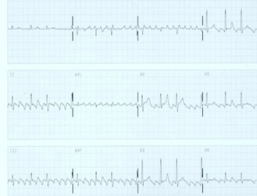 Patient presents with fluttering sensation in chest